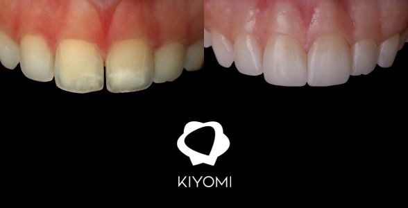 Transformación estética: el caso clínico de la Dra. Joana Souza con productos de Kiyomi Dental 